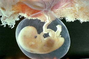 descolamento-d-placenta