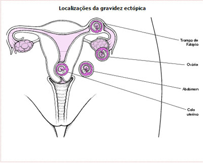 gravidez-ectopica