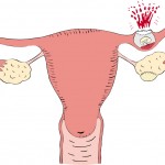 Hemorragia durante gravidez