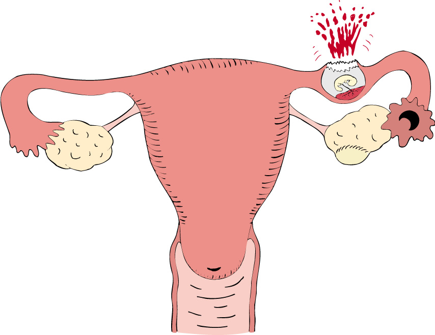 Hemorragia durante gravidez