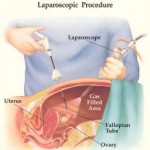 Cirurgia laparoscopia 