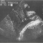 Diagnóstico da placenta prévia
