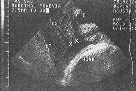 Diagnóstico da placenta prévia