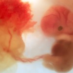 Envelhecimento da placenta
